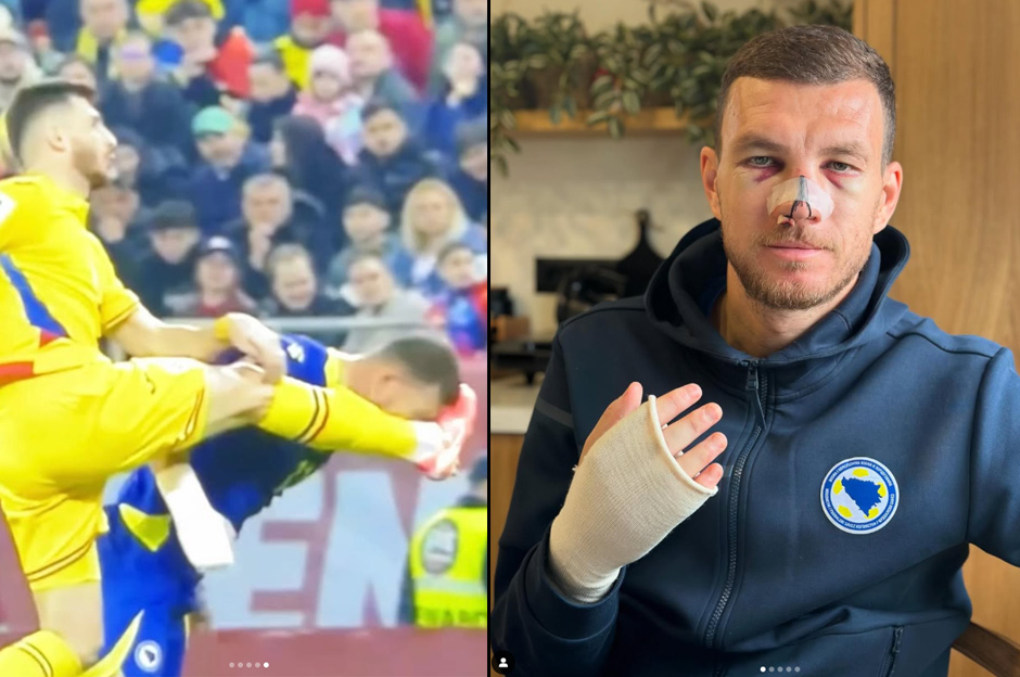 Burnu kırılan Dzeko son halini paylaştı