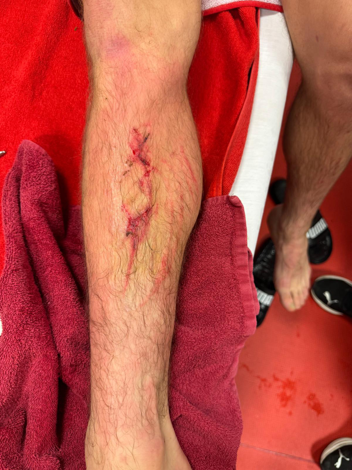 Kırmızı kart gören Roland Sallai bacağının son durumunu paylaştı