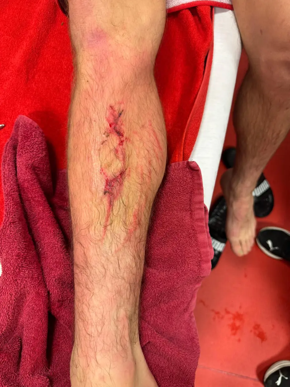 Kırmızı kart gören Roland Sallai bacağının son durumunu paylaştı - 4