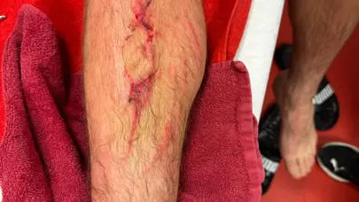 Kırmızı kart gören Roland Sallai bacağının son durumunu paylaştı